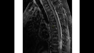 Leptomeningeal Disease LMD Symptoms [upl. by Solrac]