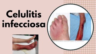 ERISIPELA y CELULITIS INFECCIOSA ¿ES CONTAGIOSA ¿Qué secuelas deja la celulitis que debo hacer [upl. by Penland]