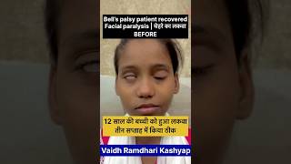 12 साल की बच्ची को हुआ चेहरे का लकवा  Facial Paralysis  bellspalsy paralysed facialparalysis [upl. by Horter213]