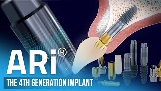 ARi  The 4th Generation Implant [upl. by Caprice]