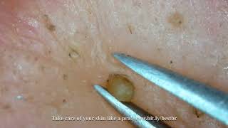 Ultimate Skincare Tips Mastering Blackhead Removal  bitlybestbr [upl. by Senecal567]