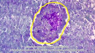 Eumycotic mycetoma under the microscope with McManus’ PAS stain [upl. by Heman]