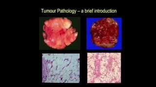 Tumour pathology  a brief introduction part III [upl. by Halyhs]