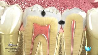 Odontología para Pacientes  La caries y la restauración [upl. by Lynnette513]