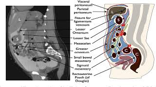 peritoneal and retroperitoneal spaces [upl. by Runck]