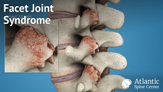 Facet Joint Syndrome [upl. by Issiah485]