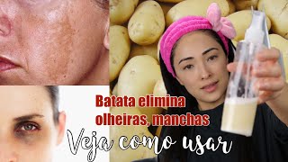 DICA COMO USAR BATATA PARA ELIMINAR OLHEIRASCLAREAR MANCHASDEIXAR SUA PELE DE PORCELANA [upl. by Engdahl541]