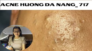 Acne Treatment Huong Da Nang 717  Remove Blackheads [upl. by Enobe]