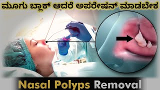 Nasal Polyps and their treatment gfacts  Top interesting facts in Kannada [upl. by Boony687]