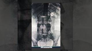 Xray lumber spine Ap examxraytechnician anatomy humananatomy humanbody radiologycareer [upl. by Izmar]