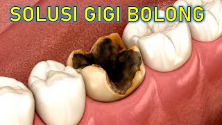 Bukan DICABUT bukan DITAMBAL‼️ Ini solusi GIGI BERLUBANG‼️ [upl. by Aikcin]