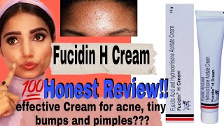 Fucidin H Cream 100 Honest Review amp Uses  Say no to Tiny Bumps  Acne and Pimples  Myra Sharma [upl. by Normalie]