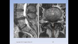 Lumbar Spinal Stenosis Cauda Equina Syndrome Sciatica amp Disc Herniation An Advanced Lecture [upl. by Margarethe]