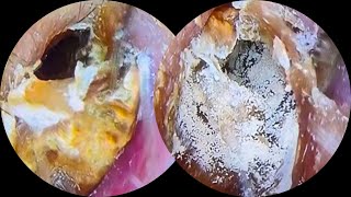 Thick fungus dry earwax removal asmrearwax 22 [upl. by Parrnell]