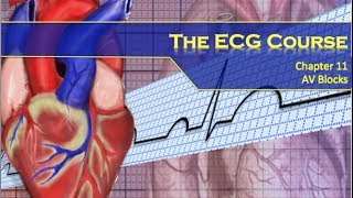 The ECG Course  AV Blocks [upl. by O'Kelly362]