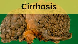 Cirrhosis  Pathology mini tutorial [upl. by Ninos]