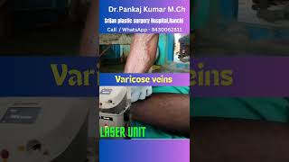 Laser treatment of varicose veins varicose veins surgery shorts varicoseveins [upl. by Day]