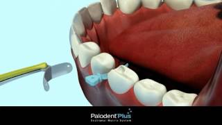 Palodent Plus Sectional Matrix System overview [upl. by Auqinaj]