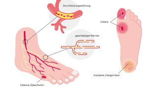 Diabetisches Fußsyndrom [upl. by Regni]