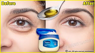 In 3 days Remove Under Eye Bags Completely  Remove Dark Circle Wrinkles Puffy Eyes [upl. by Arsuy482]