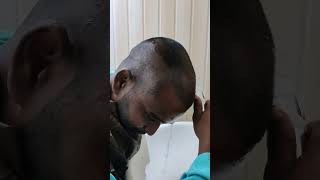 Head wash kaise Kiya jata haihairtransplant hairgrowth hairtransplantation trending ytshorts [upl. by Akli]