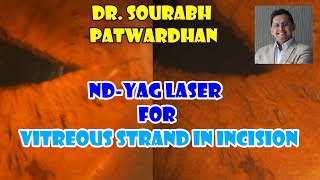 Yag Vitreolysis for vitreous strand in incision Dr Sourabh patwardhan  steps to prevent and treat [upl. by Conlee]