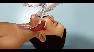 Pediatric Endotracheal Intubation by J Nagler et al  OPENPediatrics [upl. by Francie852]