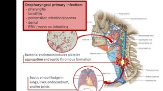 Mystery diagnosis lemierres disease [upl. by Triley818]