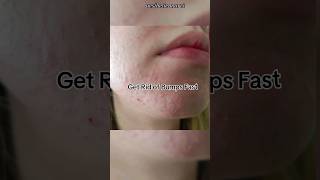 How to get rid of bumps 🙌 shorts acne bumps skincare [upl. by Amato]