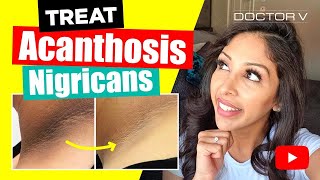 Doctor V  How To Treat Acanthosis Nigrican  Skin Of Colour  Brown Or Black Skin [upl. by Mady]