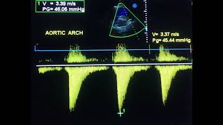 A doppler study clue in coarctation of aorta to drahmadmirdamadisiIXrrx4whO5XRtBV [upl. by Yrogreg]