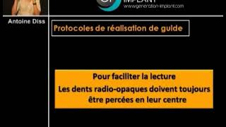 Implant dentaire  les guides radiologiques [upl. by Magnien770]