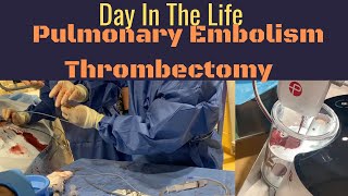 Interventional Radiology  Day in the Life  Episode 2  PE Thrombectomy [upl. by Lipinski]