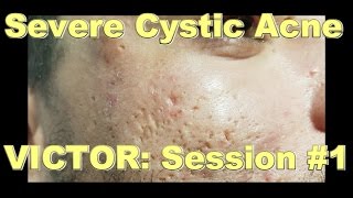 Severe Cystic Acne  Victor Session 1 [upl. by Burhans]