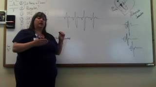 Junctional Rhythms Video 4 [upl. by Wadsworth]