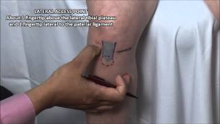 Knee Injection  Anterior Approach [upl. by Campman]