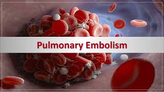 Pulmonary Embolism  الانصمام الرئوي [upl. by Sybila]