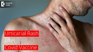 URTICARIAL RASH AFTER COVID VACCINE  How long does it last  Dr Surekha Tiwari  Doctors Circle [upl. by Scrivings]