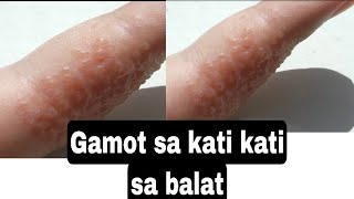 Paano ko nagamot ang Dyshidrotic Eczema o kati kati sa balat [upl. by Irby906]