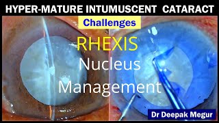 Hypermature intumescent cataract  Challenges Rhexis and Nucleus management Dr Deepak Megur [upl. by Kilan]