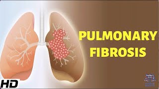 Pulmonary Fibrosis Everything You Need To Know [upl. by Zahc]