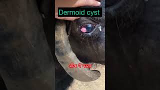 Dermoid cyst l dr Umar khan [upl. by Imer]