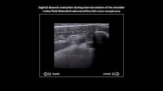 Subcoracoid bursitis on shoulder ultrasound [upl. by Aineval]