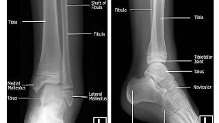 Age Estimation from Ankle Xray [upl. by Auqenehs]