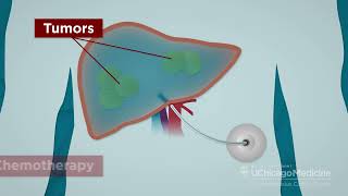 Hepatic Artery Infusion HAI Pump Chemotherapy for Liver Metastases [upl. by Liddie281]