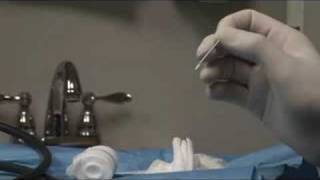 Foot Cryosurgery for Foot Neuroma [upl. by Eenal729]