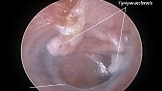 Otoendoscopy  Naturally healed central perforation of eardrum with Tympanosclerosis [upl. by Wier]