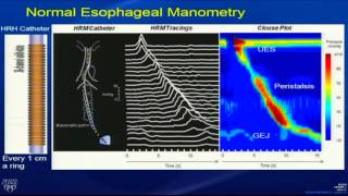Manometría Esofágica de alta resolución [upl. by Aidne837]