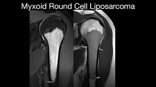 Myxoid Round Cell Liposarcoma [upl. by Neala]