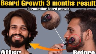 Dermaroller for beard growth  Derma roller beard before and after  Beard Products [upl. by Elletsyrk261]